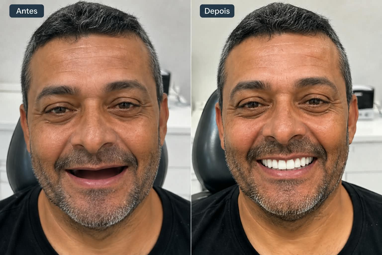 Antes e depois — Prótese Protocolo
